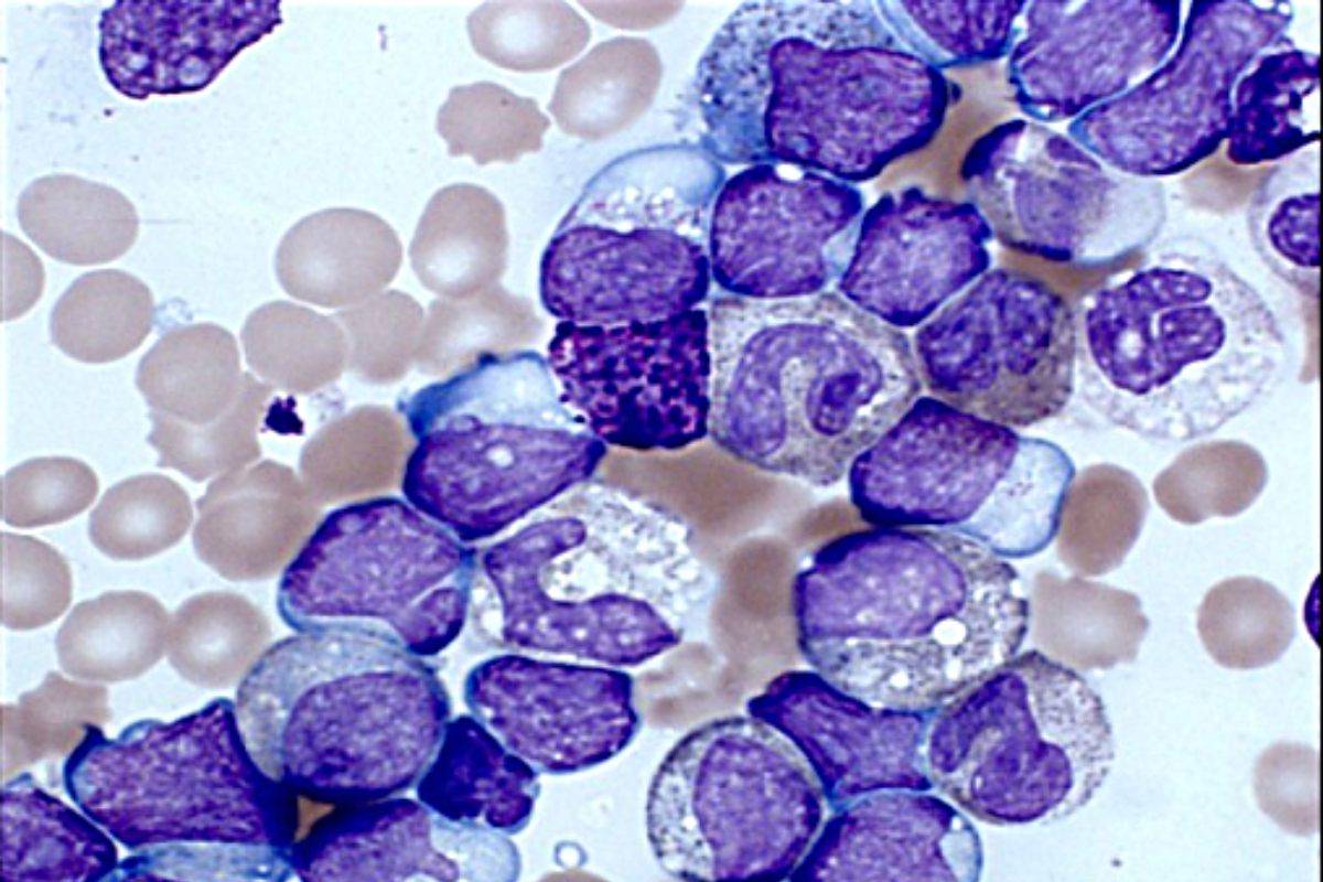 Células de leucemia mieloide aguda. 